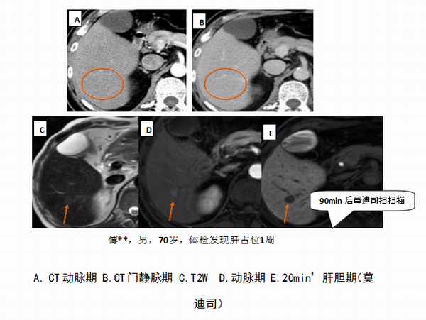 肝特异性对比剂在肝癌诊疗中的价值