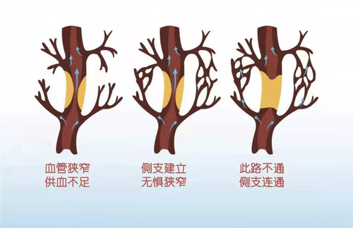 缺血性心脏病治疗新选择1.jpg