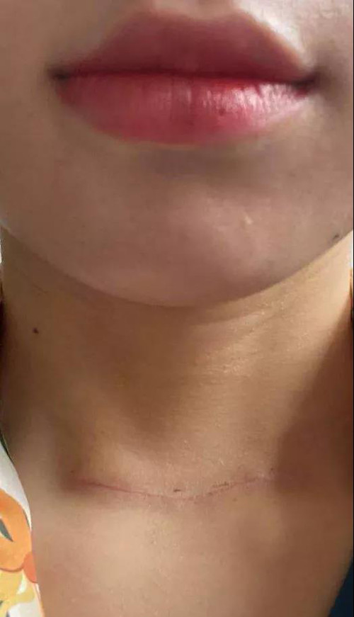 花季少女罹患甲状腺癌2.jpg