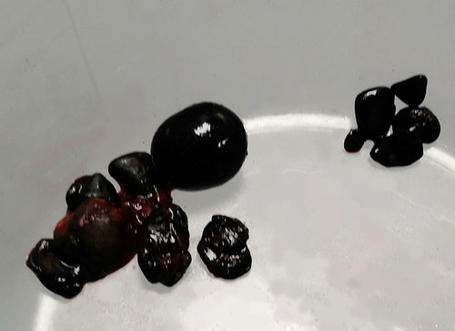 胆结石病人乳山度假突发急性胆管炎3.jpg