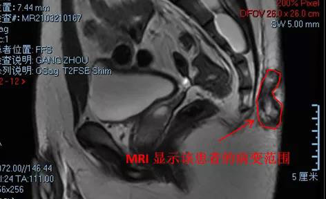 藏毛窦1.jpg