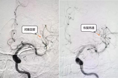 85岁突发急性脑梗2.jpg