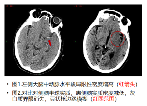 突发肢体活动不灵怀疑急性脑梗1.png