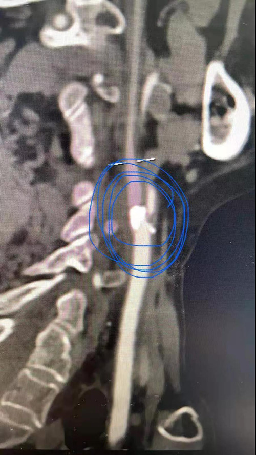 七旬老人突然一阵言语不清1.jpg