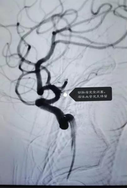 82岁老人脑动脉瘤破裂深昏迷3.jpg