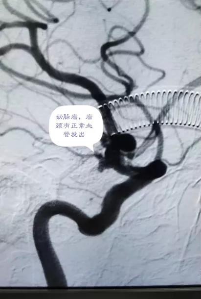 82岁老人脑动脉瘤破裂深昏迷1.jpg