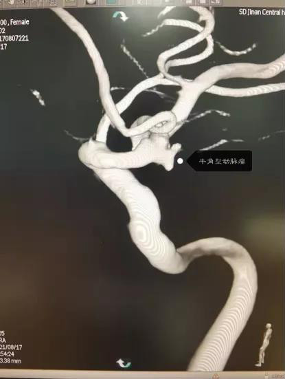 82岁老人脑动脉瘤破裂深昏迷2.jpg