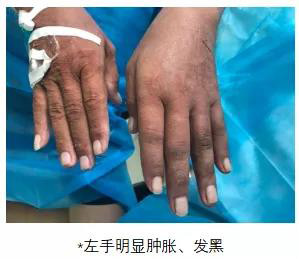 窃血综合征1.jpg