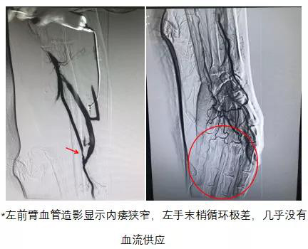 窃血综合征2.jpg