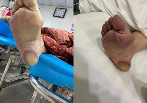 南山80岁老人右下肢血栓转诊中心医院1.jpg