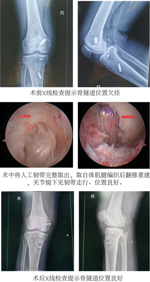 韧带术后仍疼痛1.jpg