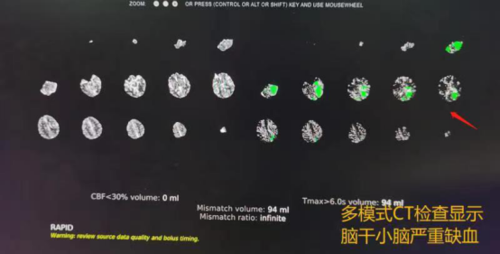 手腕取栓2.png