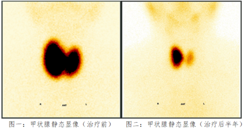 甲亢复发1.png