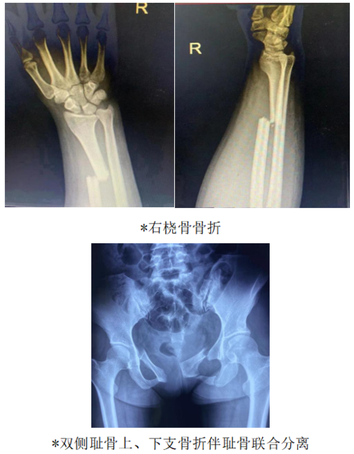 骨折.png